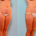 Liposuction before and after photos in Houston, TX, Patient 29182