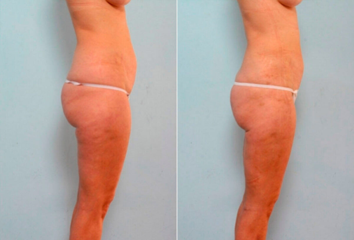 Liposuction before and after photos in Houston, TX, Patient 29182