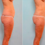 Liposuction before and after photos in Houston, TX, Patient 29182