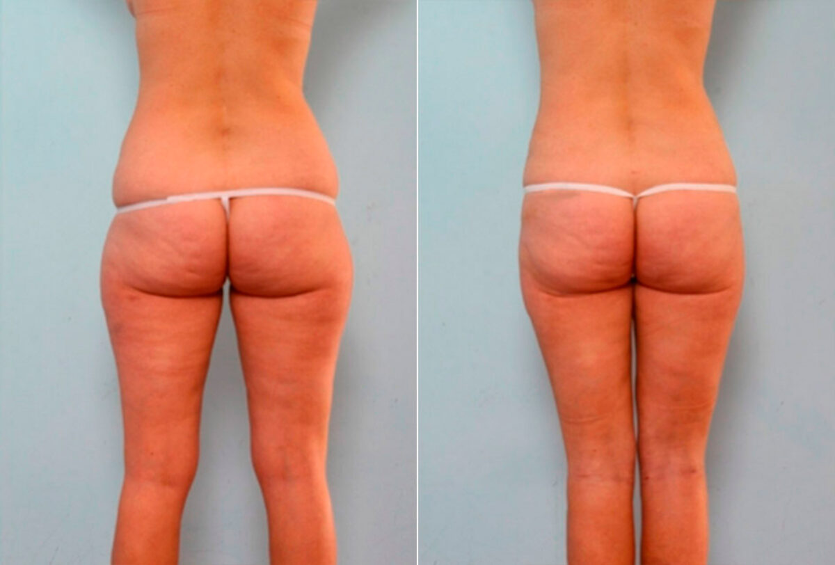 Liposuction before and after photos in Houston, TX, Patient 29182