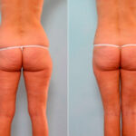 Liposuction before and after photos in Houston, TX, Patient 29182