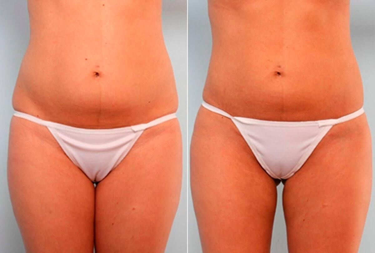 Liposuction before and after photos in Houston, TX, Patient 29191