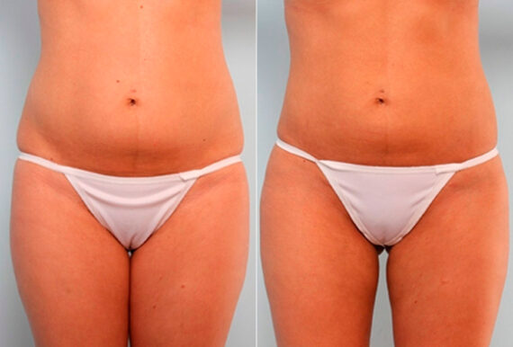 Liposuction before and after photos in Houston, TX, Patient 29191