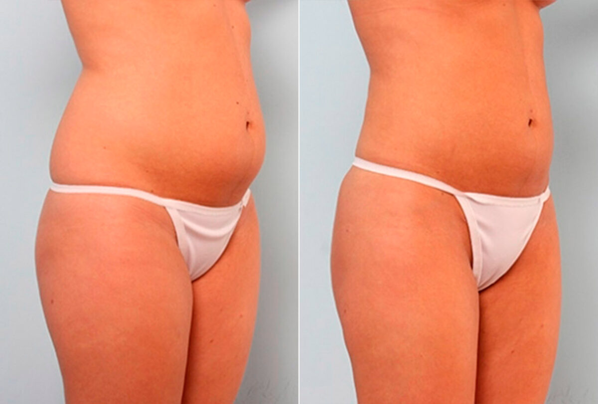 Liposuction before and after photos in Houston, TX, Patient 29191