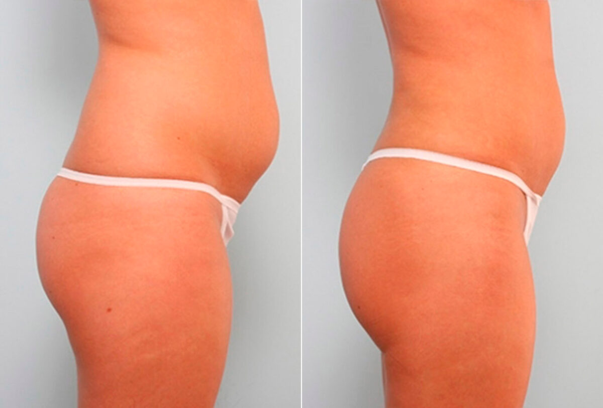 Liposuction before and after photos in Houston, TX, Patient 29191