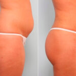 Liposuction before and after photos in Houston, TX, Patient 29191