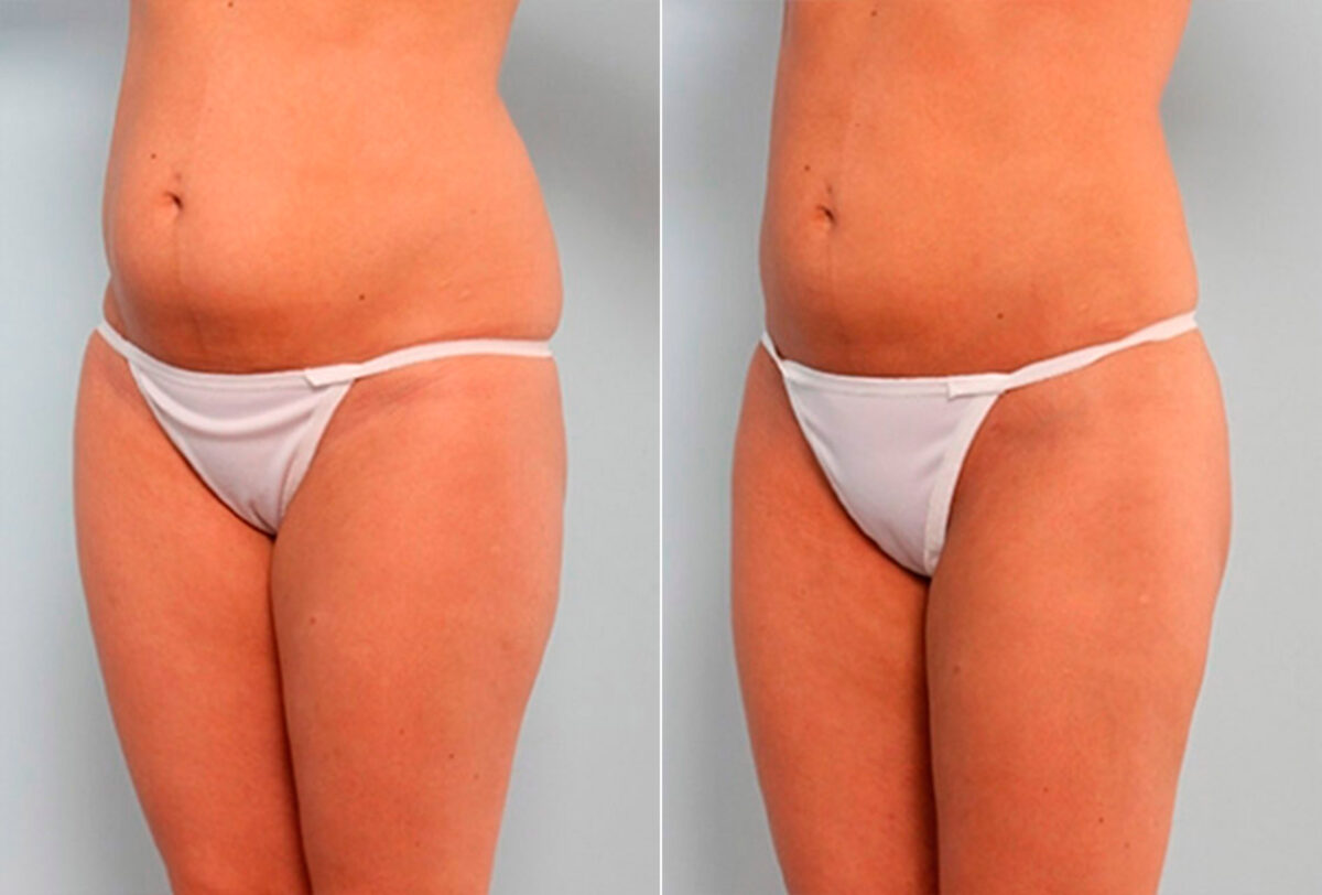 Liposuction before and after photos in Houston, TX, Patient 29191