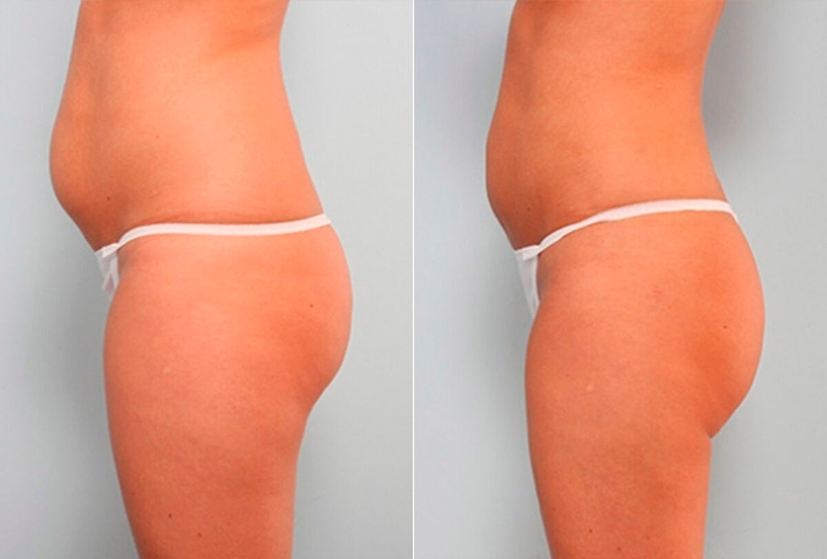 Liposuction before and after photos in Houston, TX, Patient 29191