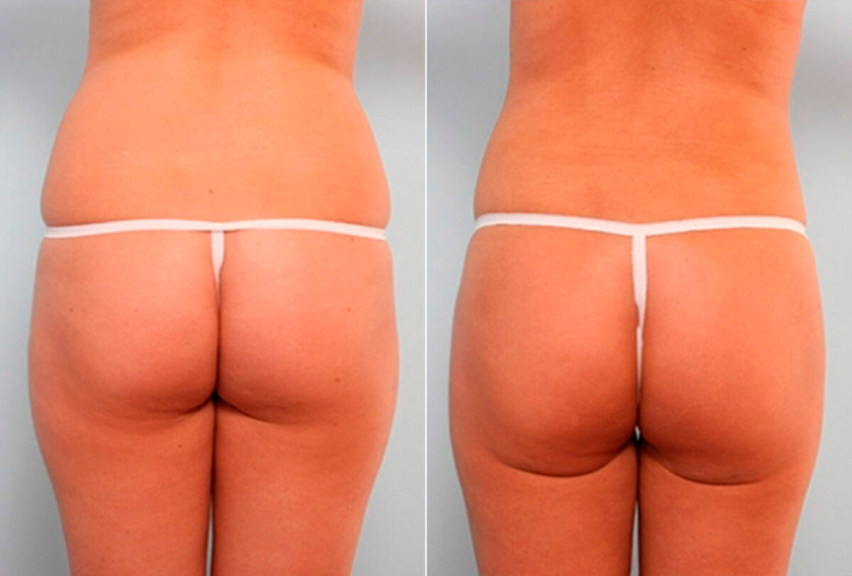 Liposuction before and after photos in Houston, TX, Patient 29191