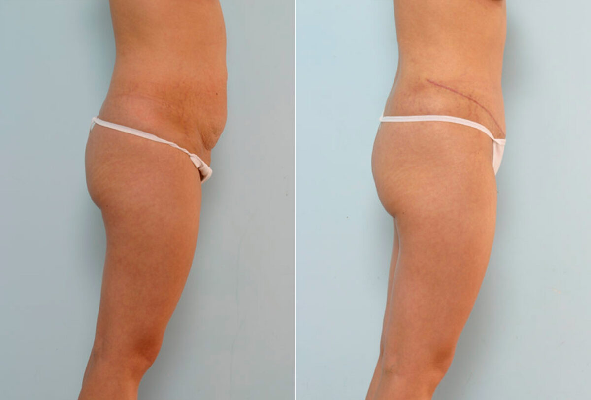 Abdominoplasty before and after photos in Houston, TX, Patient 24243