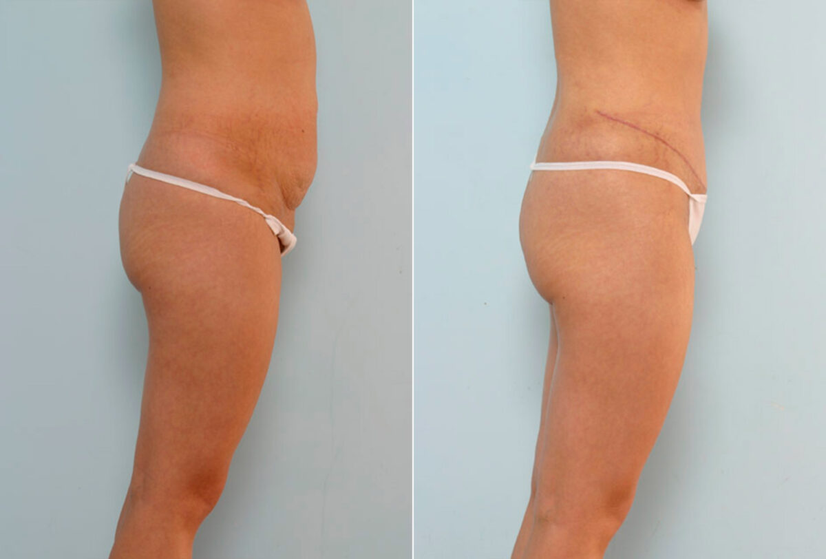 Tummy Tuck/Abdominoplasty before and after photos in Houston, TX, Patient 24243