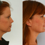 Neck Lift before and after photos in Houston, TX, Patient 29321