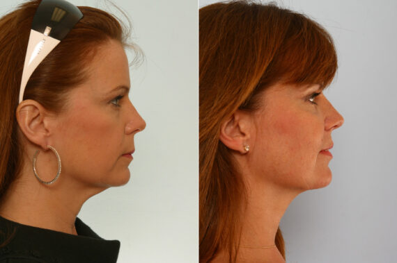 Neck Lift before and after photos in Houston, TX