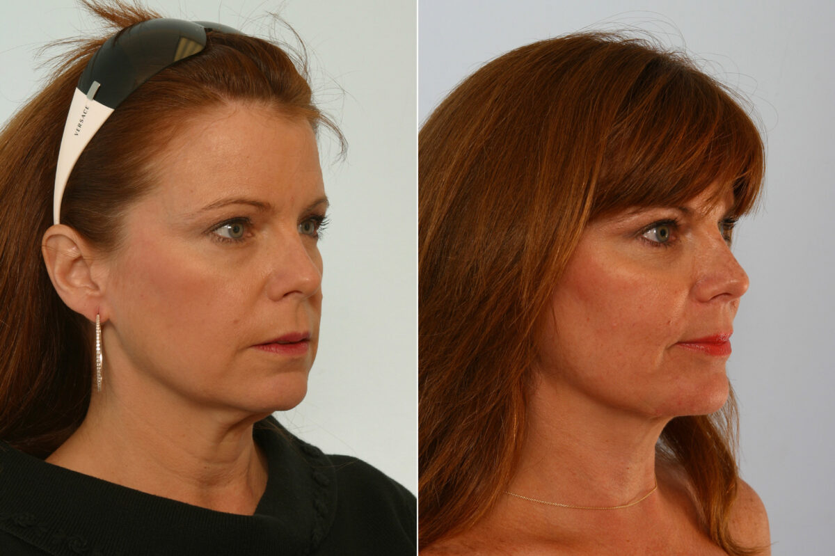 Neck Lift before and after photos in Houston, TX, Patient 29321