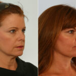 Neck Lift before and after photos in Houston, TX, Patient 29321