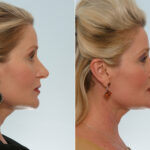 Neck Lift before and after photos in Houston, TX, Patient 29326