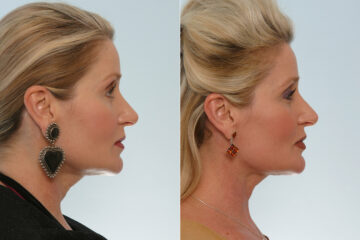 Neck Lift before and after photos in Houston, TX, Patient 29326