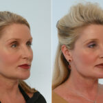 Neck Lift before and after photos in Houston, TX, Patient 29326