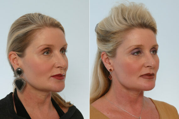 Neck Lift before and after photos in Houston, TX, Patient 29326