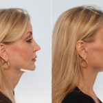 Neck Lift before and after photos in Houston, TX, Patient 29336