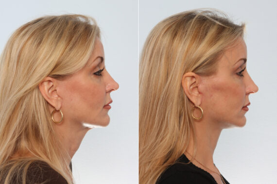 Neck Lift before and after photos in Houston, TX, Patient 29336