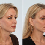 Neck Lift before and after photos in Houston, TX, Patient 29336