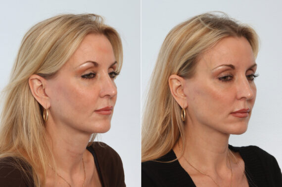 Neck Lift before and after photos in Houston, TX, Patient 29336