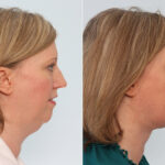 Neck Lift before and after photos in Houston, TX, Patient 29346