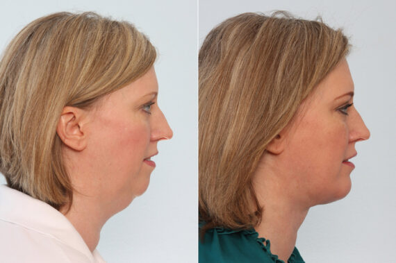 Neck Lift before and after photos in Houston, TX, Patient 29346