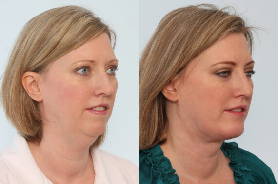 Neck Lift before and after photos in Houston, TX, Patient 29346