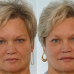 Radiesse before and after photos in Houston, TX, Patient 29412