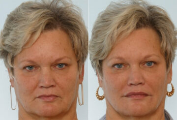 Radiesse before and after photos in Houston, TX, Patient 29412