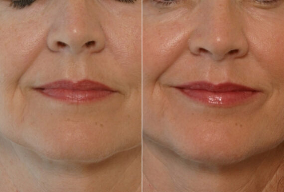 Radiesse before and after photos in Houston, TX, Patient 29415
