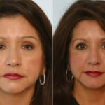 Radiesse before and after photos in Houston, TX, Patient 29432