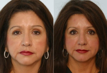 Radiesse before and after photos in Houston, TX, Patient 29432