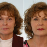 Radiesse before and after photos in Houston, TX, Patient 29435