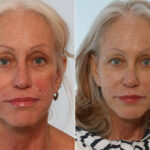 Radiesse before and after photos in Houston, TX, Patient 29445