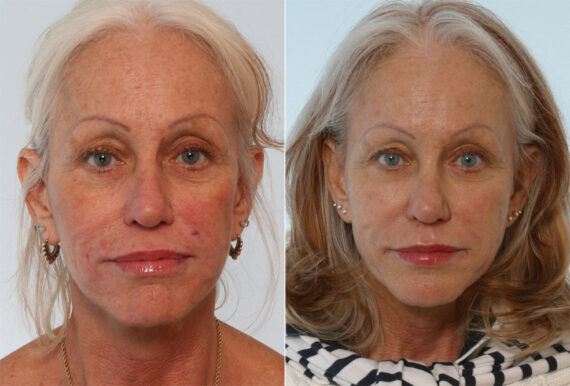 Radiesse before and after photos in Houston, TX, Patient 29445