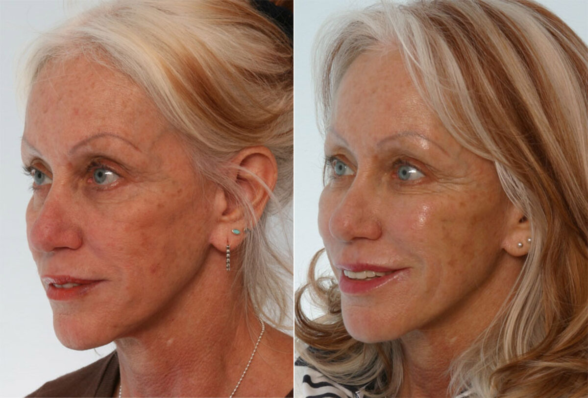Radiesse before and after photos in Houston, TX, Patient 29445