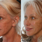 Radiesse before and after photos in Houston, TX, Patient 29445