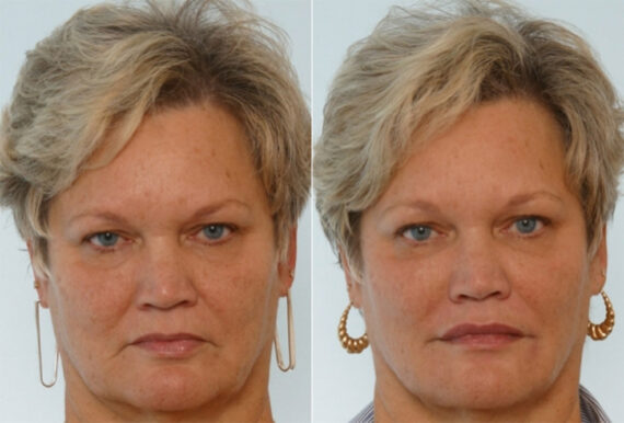 Restylane before and after photos in Houston, TX