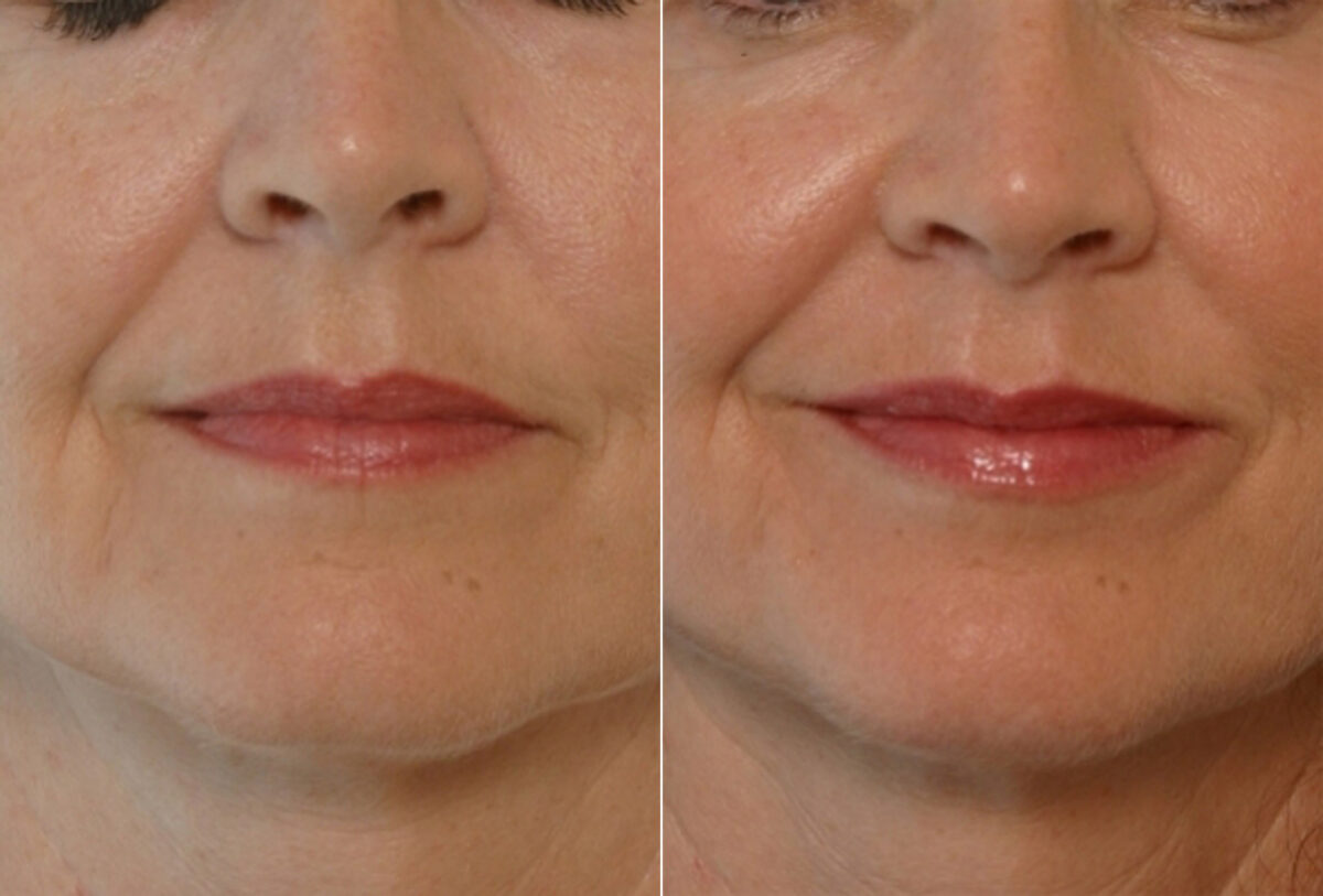 Restylane before and after photos in Houston, TX, Patient 29453