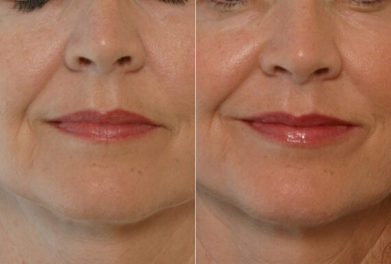 Restylane before and after photos in Houston, TX, Patient 29453