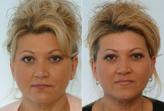 Restylane before and after photos in Houston, TX, Patient 29459