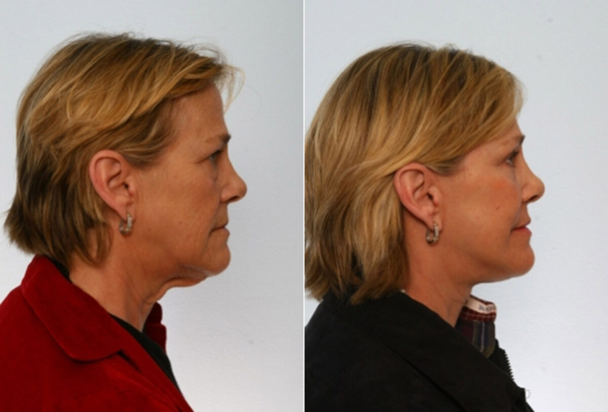 Restylane before and after photos in Houston, TX, Patient 29467