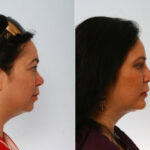 Rhinoplasty before and after photos in Houston, TX, Patient 29479