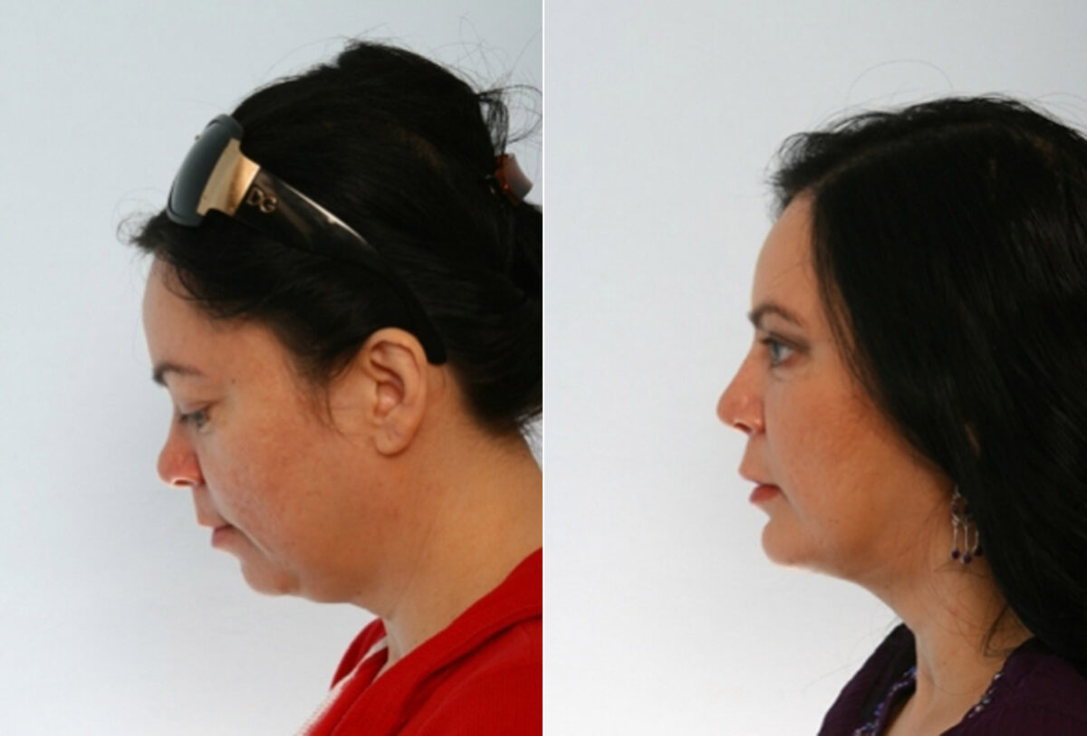 Rhinoplasty before and after photos in Houston, TX, Patient 29479