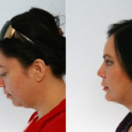 Rhinoplasty before and after photos in Houston, TX, Patient 29479