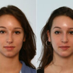 Rhinoplasty before and after photos in Houston, TX, Patient 29490