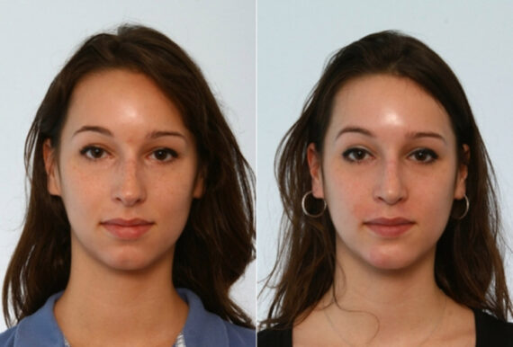 Rhinoplasty before and after photos in Houston, TX